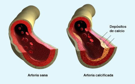 Arteria sana y arteria con depósitos calcio.