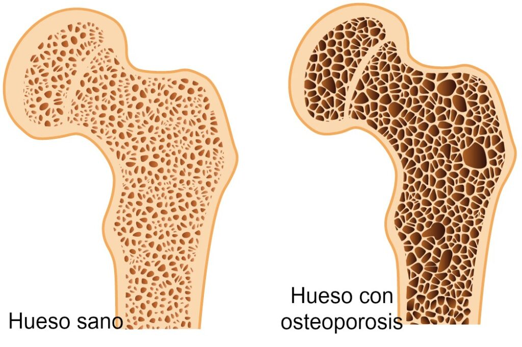 Comparación hueso sano y hueso con osteoporosis.